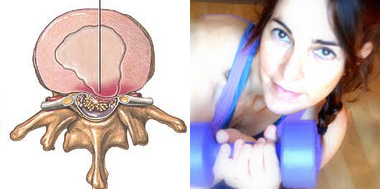 Hernia discal ¿Qué es? ¿Qué hacer para aliviar dolor?
