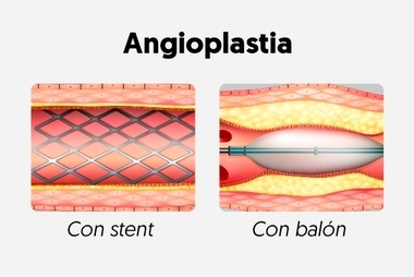 La angioplastia primaria en el infarto es un 15% menos frecuente en mujeres que en hombres